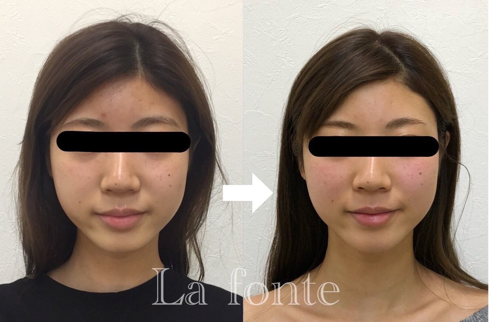 Before写真撮影