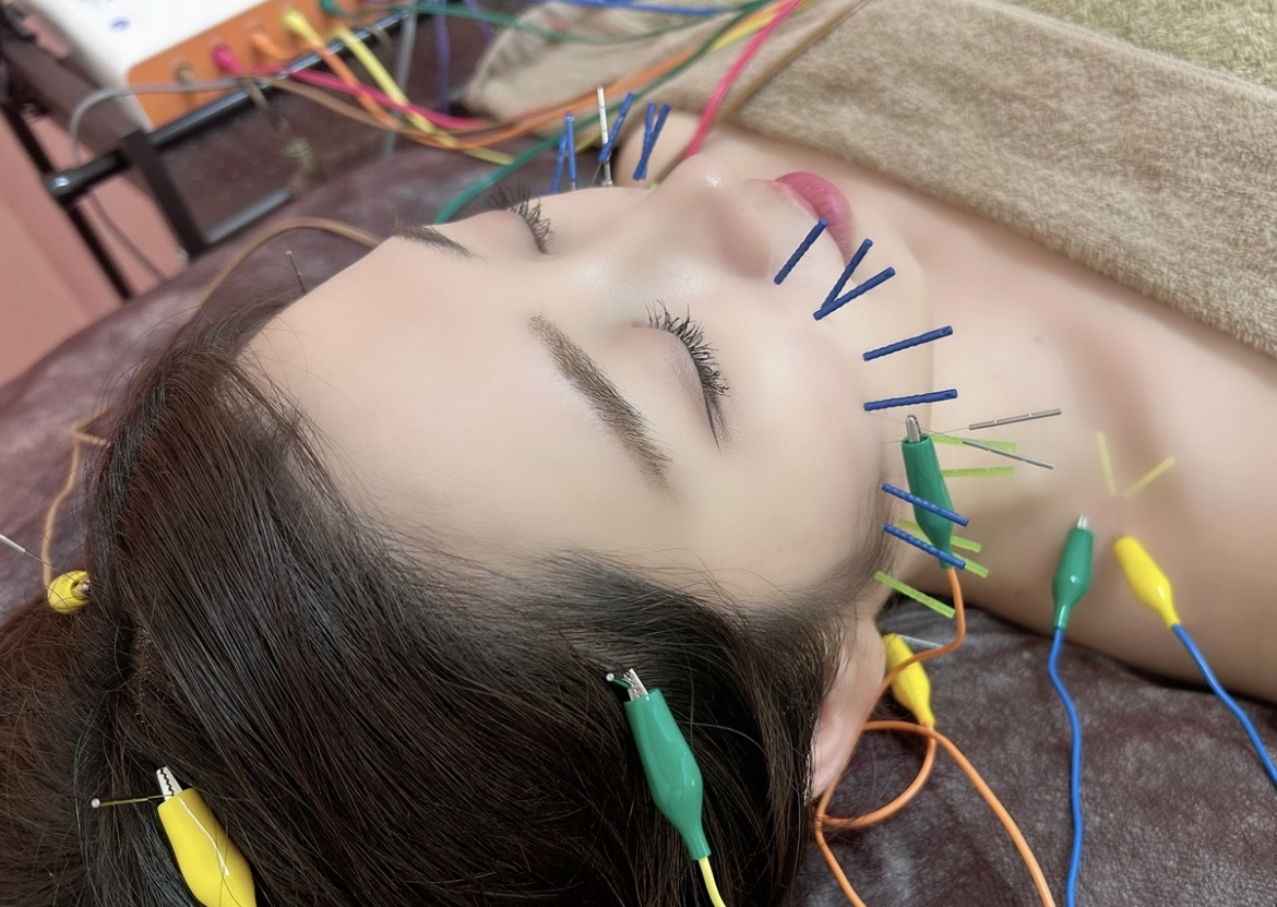 電気を流す美容鍼