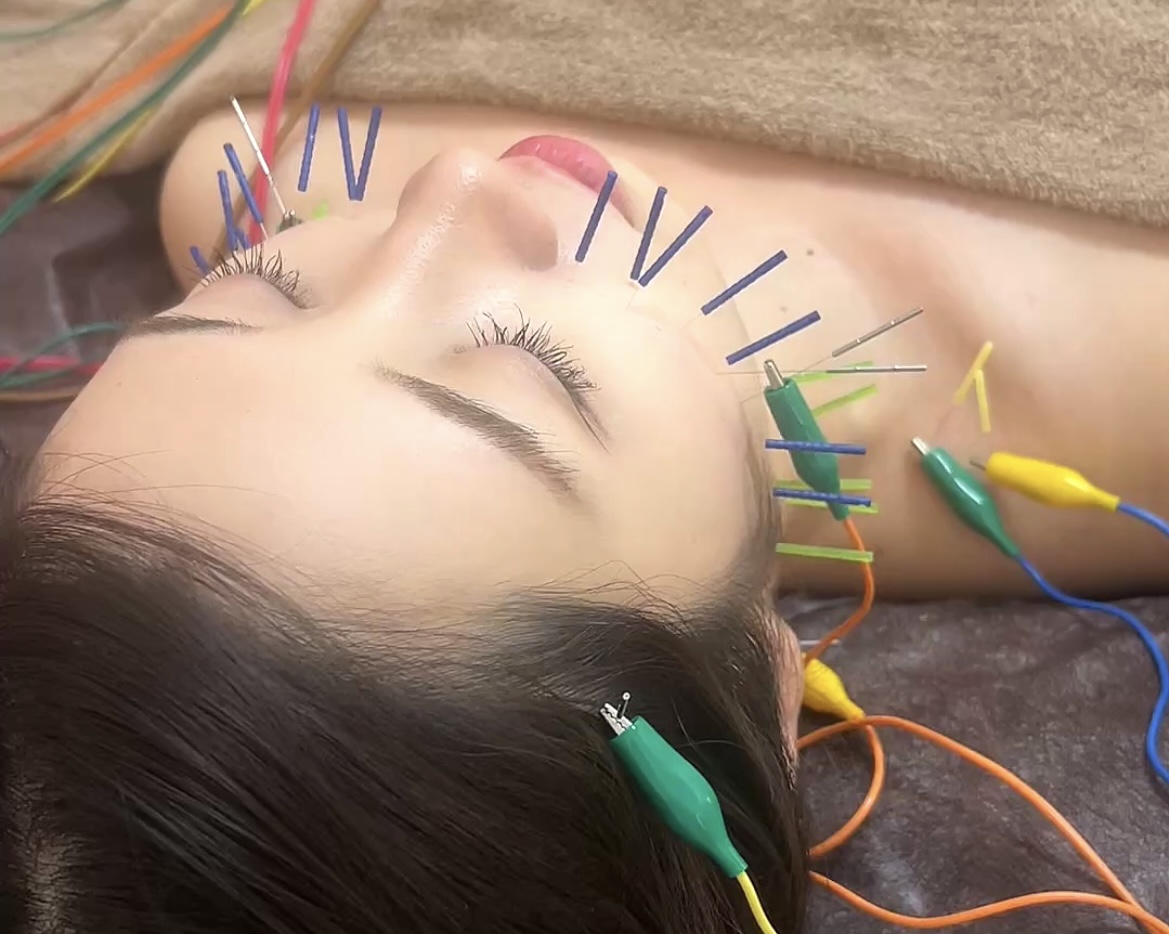 電気を流す美容鍼